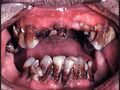 Crack/Meth Teeth