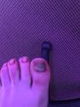 Her rotten toenails