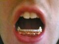 Dude, invest in braces. Not some fugly grill/retainer thing.