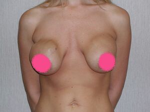 PS-Breasts6.jpg