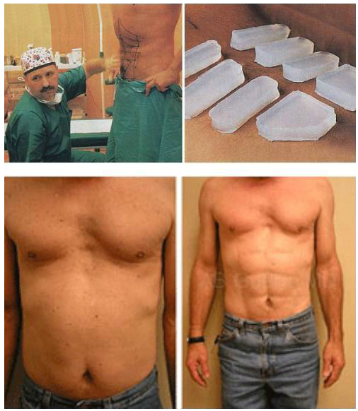 File:Plastic Surgery - Fake Abs.jpg