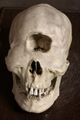 A skull typical of a sufferer of synophthalmia (a form of the rare birth defect holoprosencephaly.)